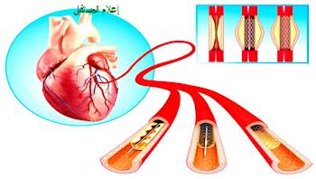 قسطرة القلب: تعريفها-الغرض منها-آلية العمل