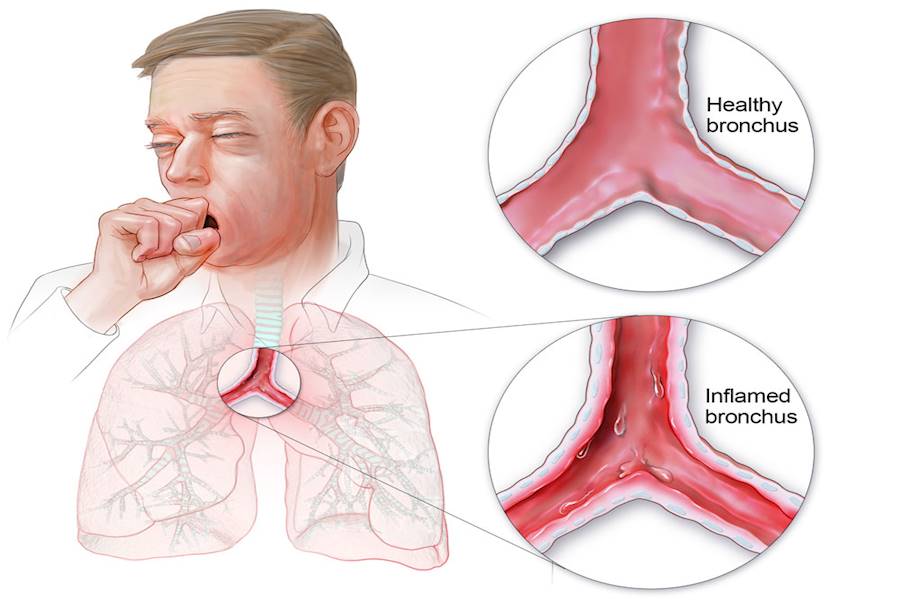 أمراض الجهاز التنفسي و طرق الوقاية منها