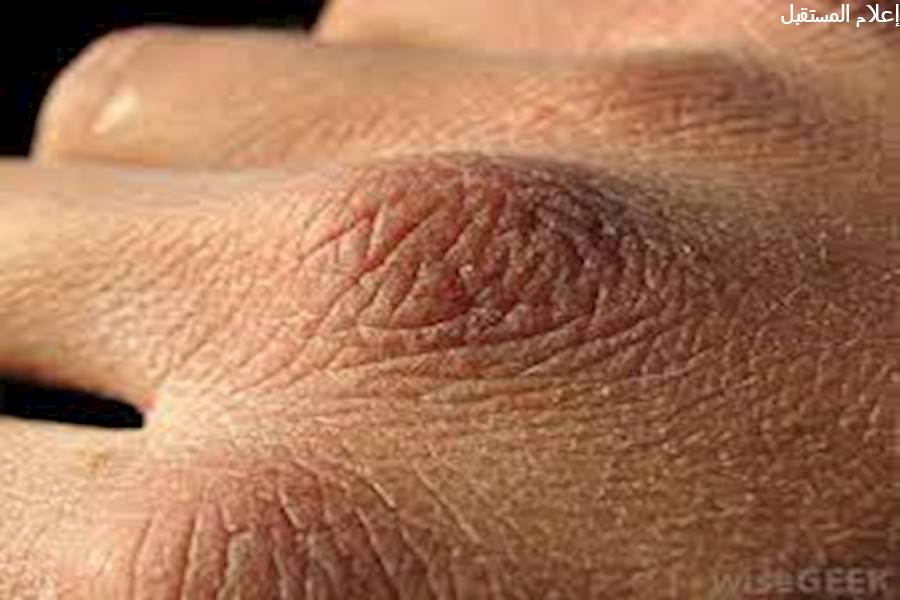 أسباب جفاف الجلد و الوقاية منه وطرق العلاج