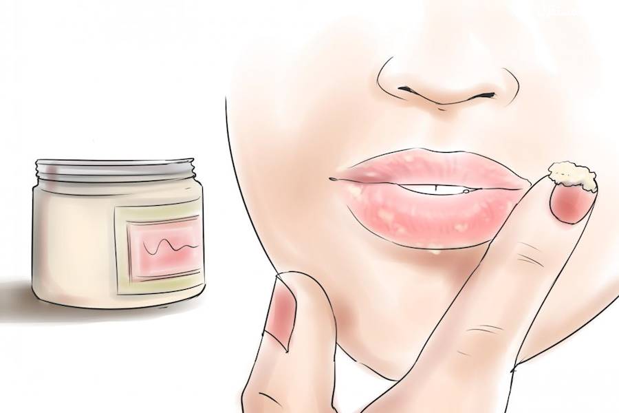 علاج الاسمرار حول الفم