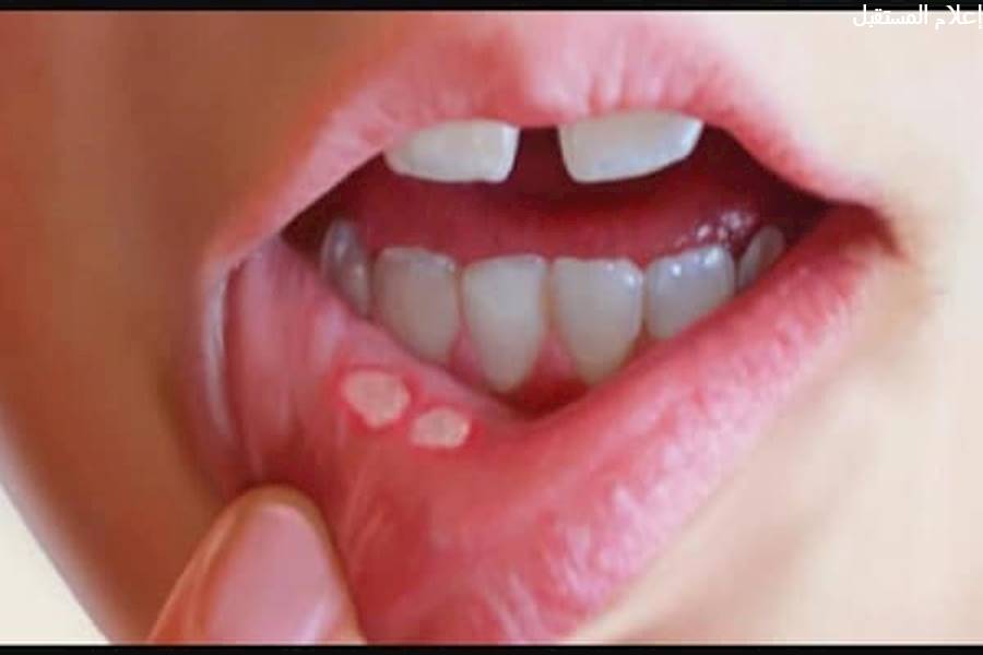 اسباب وعلاج القرحة الفموية أو ما يعرف بألتهاب الفم القلاعي 